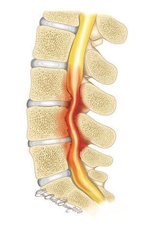 Torasik omurganın osteokondrozu ile spinal kanalın sıkışması meydana gelir. 