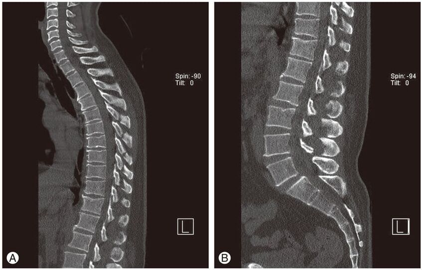 Torasik osteokondrozda MRI görüntülerinde intervertebral disklerin deformasyonu