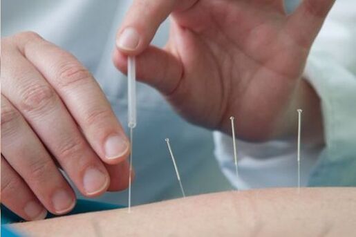 Akupunktur - bel bölgesinde osteokondrozun neden olduğu ağrıyı tedavi etme yöntemi
