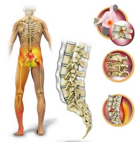 Lomber omurganın osteokondrozu, sırt ağrısına neden olur