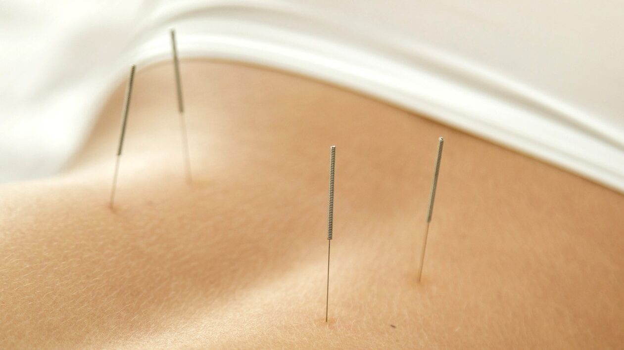 Akupunktur bel ağrısından kurtulmanıza yardımcı olacaktır